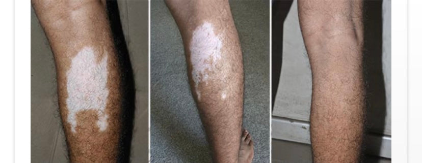 Vitiligo Organix Oil: Transform Your Skin's Pigmentation Naturally