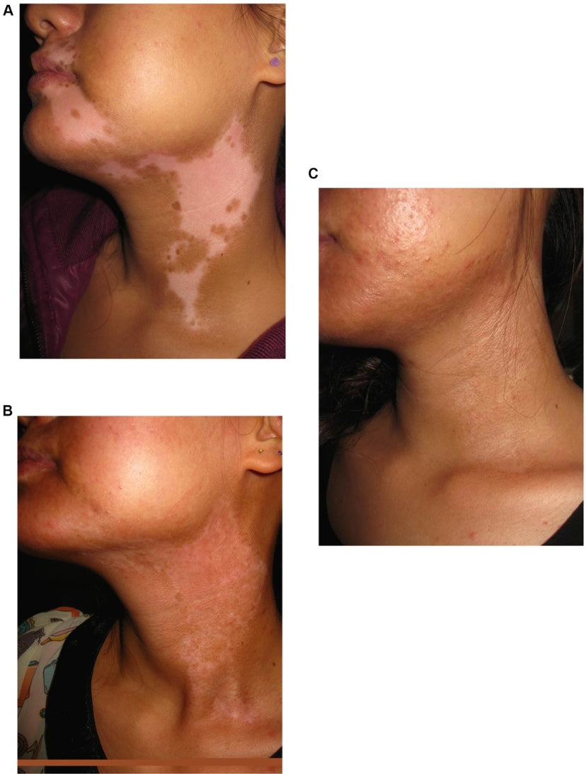 Vitiligo Organix Oil: Transform Your Skin's Pigmentation Naturally